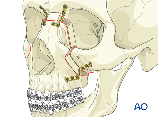 Le Fort II osteotomy for Unilateral cleft lip and/or palate ...