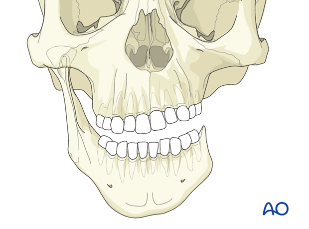 Construction of mandibular ramus and condyle for Pruzansky IIb