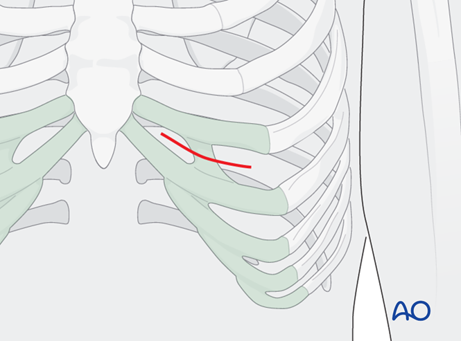 Condylar replacement - Autogenous for Mandibular nonunion - TMJ Dysfunction