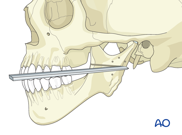 Distraction osteogenesis of mandibular ramus for Pruzansky III