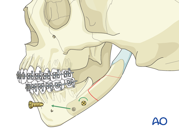 Lateral augmentation by osteotomy for Pruzansky IIb