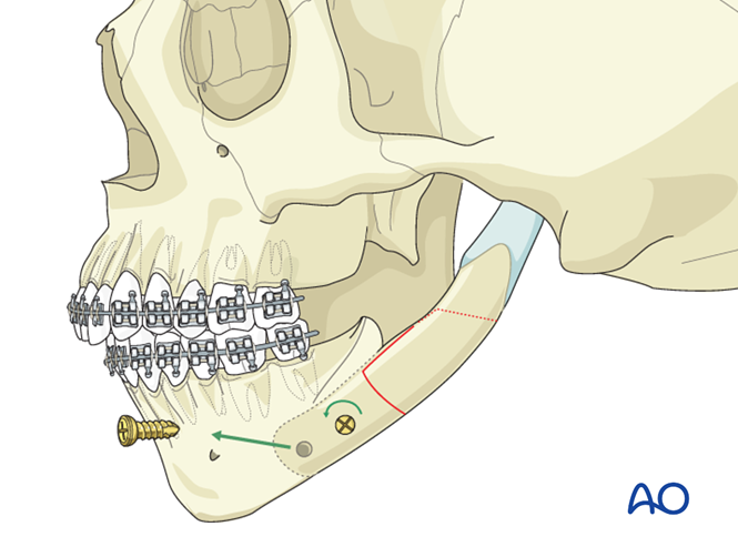 Lateral augmentation by distraction osteogenesis for Pruzansky III