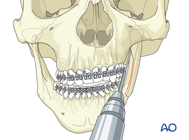 Lateral augmentation by osteotomy for Pruzansky IIb