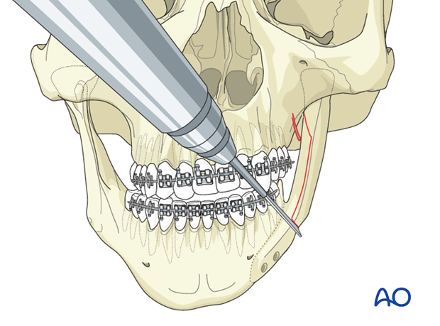 Lateral augmentation by osteotomy for Pruzansky III