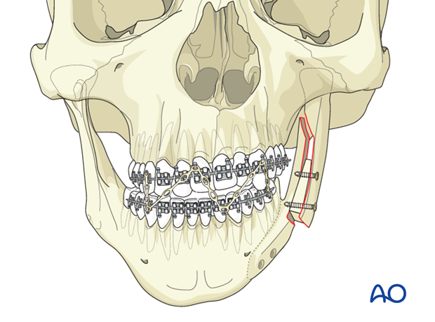 Lateral augmentation by osteotomy for Pruzansky IIb
