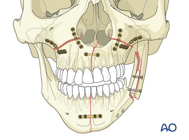 Illustrated Periodontal Surgery 西川雄島著 Illustrated Periodontal Microsurgery: Advanced Technique