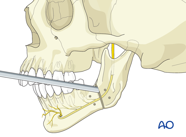 Mandibular advancement by distraction osteogenesis for