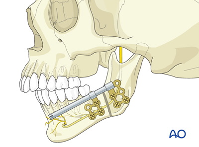 Mandibular advancement by distraction osteogenesis for Treacher Collins ...