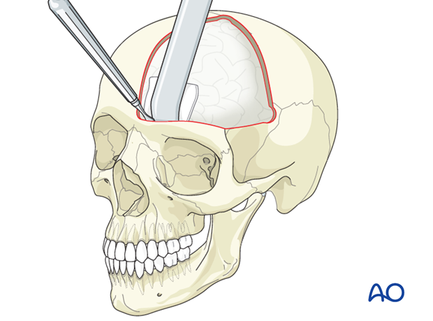 Four wall box osteotomy for Pruzansky IIb