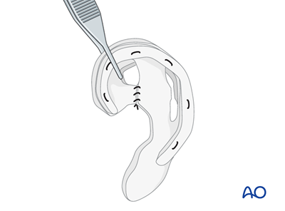 Autogenous ear construction for Pruzansky I