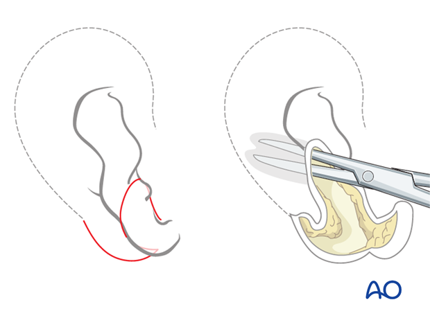Autogenous ear construction for Pruzansky I
