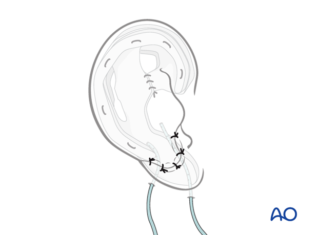 Autogenous ear construction for Pruzansky I