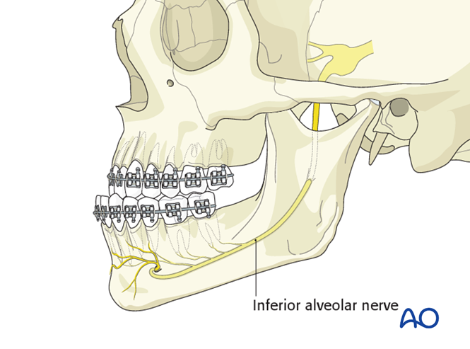 BSSO (Obwegeser) for Vertical mandibular hyperplasia