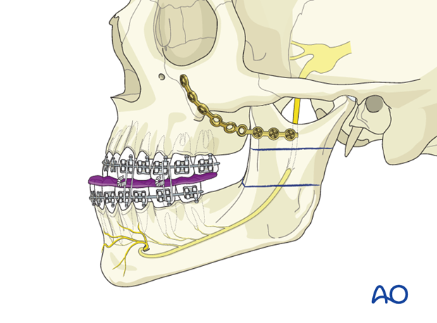 BSSO (Obwegeser) for Vertical mandibular hyperplasia