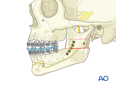 BSSO (Obwegeser) for Vertical mandibular hyperplasia