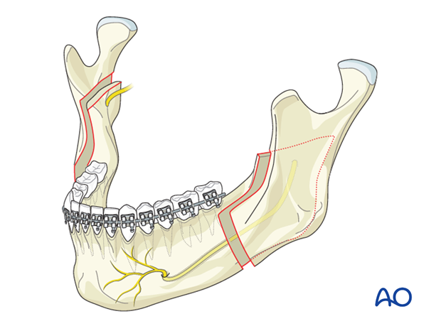 BSSO (Obwegeser, Dal Pont) for Mandibular prognathism