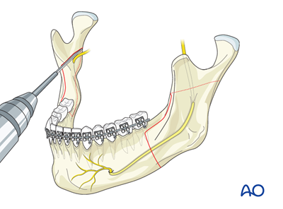 BSSO (Obwegeser, Dal Pont) for Hemimandibular hyperplasia