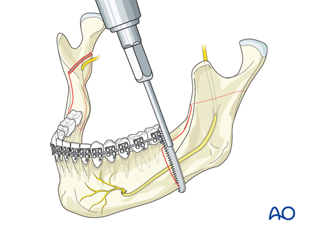 BSSO (Obwegeser, Dal Pont) for Mandibular prognathism