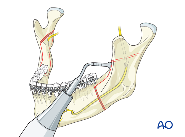 BSSO (Obwegeser, Dal Pont) for Hemimandibular hyperplasia