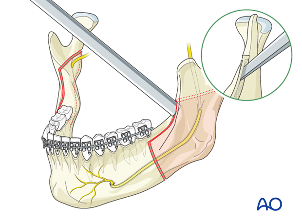 BSSO (Obwegeser, Dal Pont) for Hemimandibular hyperplasia