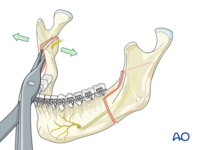 BSSO (Obwegeser, Dal Pont) for Hemimandibular hyperplasia