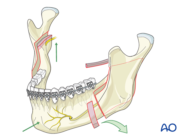 BSSO (Obwegeser, Dal Pont) for Hemimandibular hyperplasia