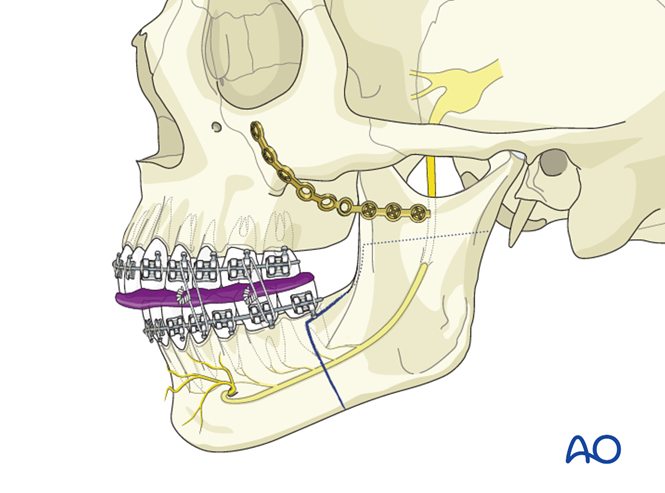 BSSO (Obwegeser, Dal Pont) for Hemimandibular hyperplasia