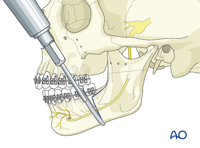 BSSO (Obwegeser, Dal Pont) for Hemimandibular hyperplasia