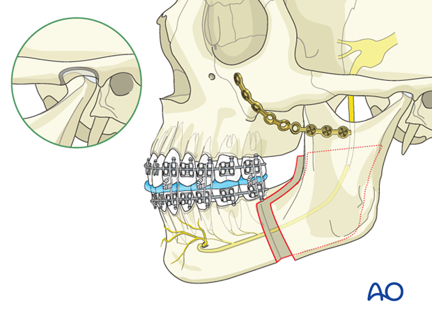 BSSO (Obwegeser, Dal Pont) for Hemimandibular hyperplasia