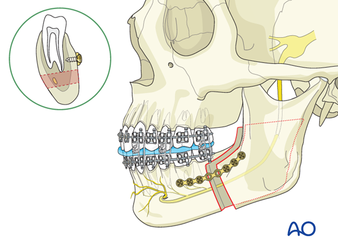 BSSO (Obwegeser, Dal Pont) for Hemimandibular hyperplasia