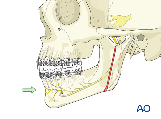 Vertical ramus osteotomy for Laterognathia