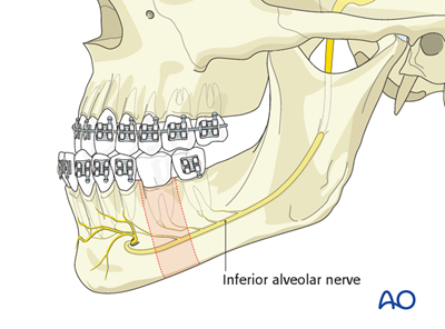 Mandibular body osteotomy (Dingman) for Transverse hyperplasia of the ...