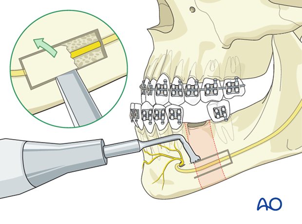 Mandibular body osteotomy (Dingman) for Mandibular retrognathism