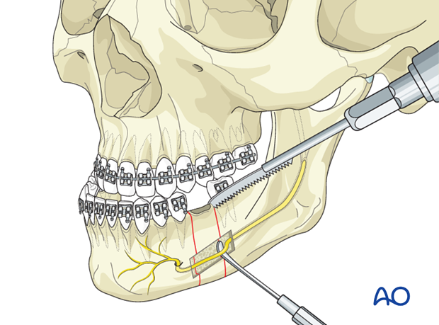 Mandibular body osteotomy (Dingman) for Transverse hyperplasia of the ...