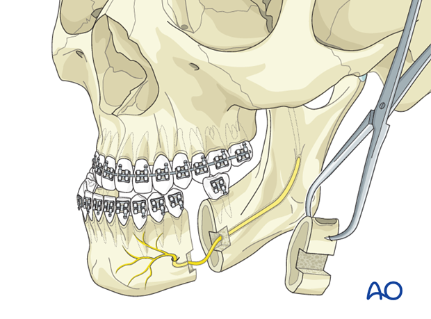 Mandibular body osteotomy (Dingman) for Transverse hyperplasia of the ...