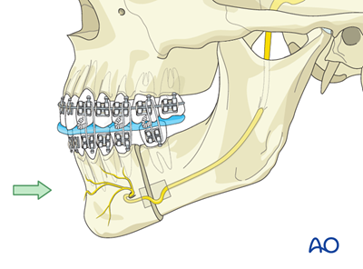 Mandibular body osteotomy (Dingman) for Mandibular retrognathism