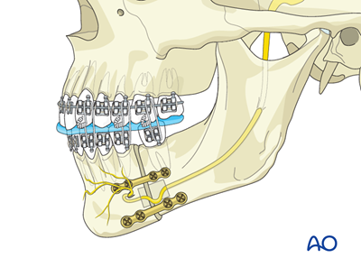 Mandibular body osteotomy (Dingman) for Mandibular retrognathism