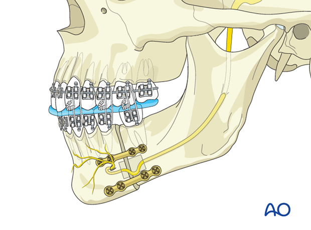 Mandibular body osteotomy (Dingman) for Mandibular retrognathism