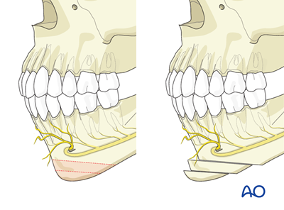 Chin osteotomy for Transverse genial hyperplasia