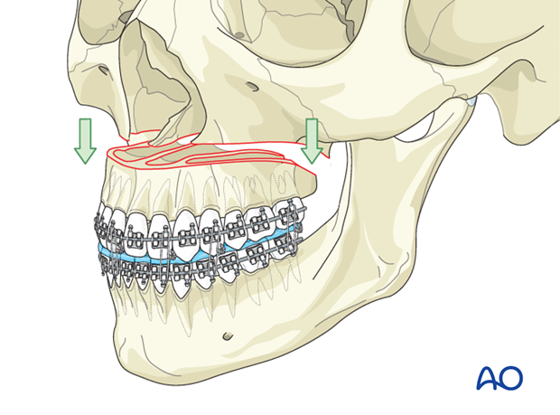 Le Fort I osteotomy for Maxillary retrognathism