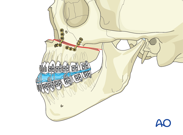 Orthognathic Surgery: Bimaxillary surgery