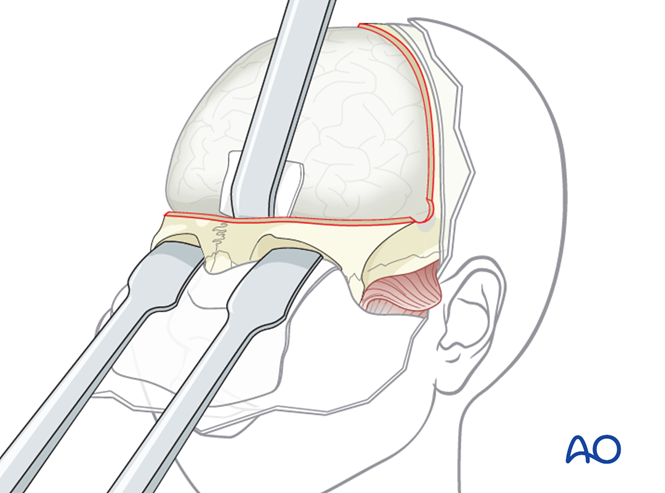 Bilateral orbital advancement for Syndromic synostosis