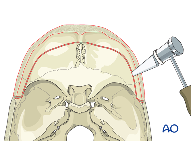 Bilateral orbital advancement for Syndromic synostosis