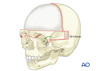Bilateral orbital advancement for Syndromic synostosis