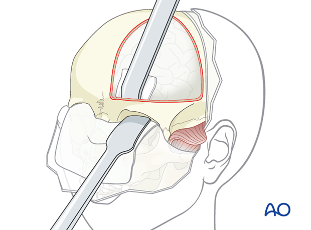 Unilateral orbital advancement for Unilateral coronal synostosis