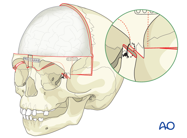 Bilateral orbital advancement and expansion for Metopic synostosis