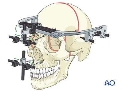 Le Fort III Monoblock - Distraction osteogenesis for Syndromic synostosis