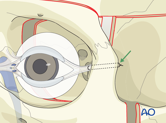 Le Fort III Monoblock - Distraction osteogenesis for Syndromic synostosis