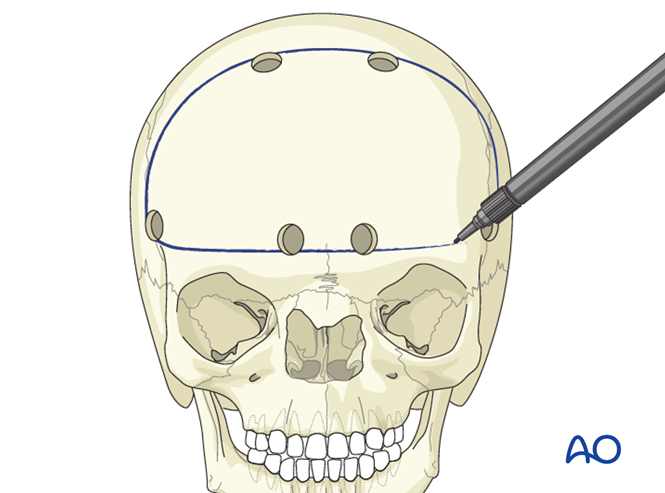 Four wall box osteotomy of the orbits for Intraorbital hypertelorism