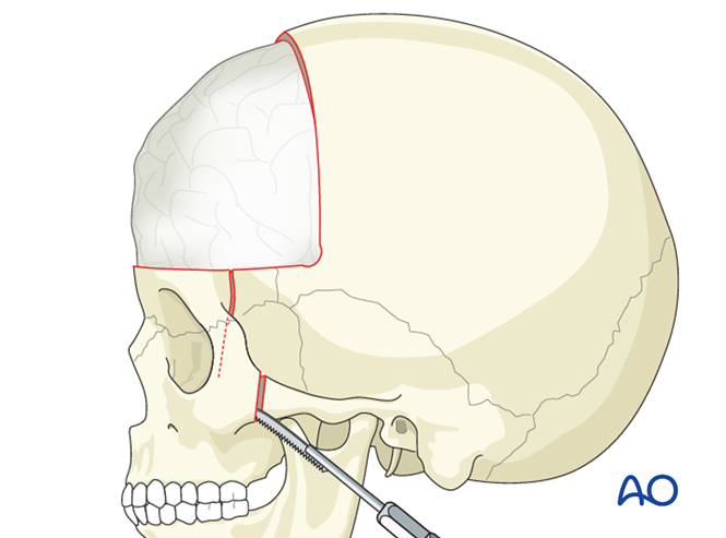 Four wall box osteotomy of the orbits for Intraorbital hypertelorism